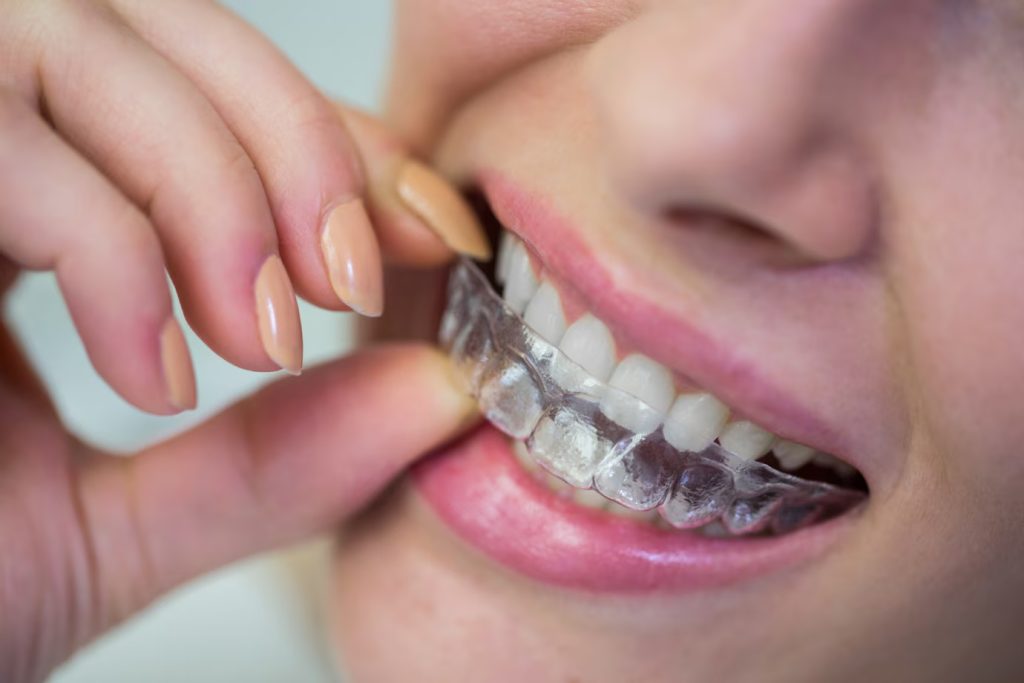 Discover the Benefits of Invisalign: A Clear Path to a Perfect Smile